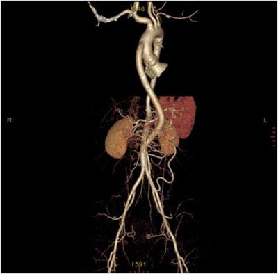 Transcriptome profiling of abdominal aortic tissues reveals alterations in mRNAs of Takayasu arteritis